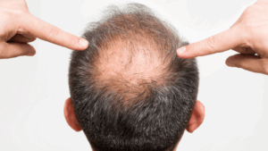 איך למנוע התקרחות