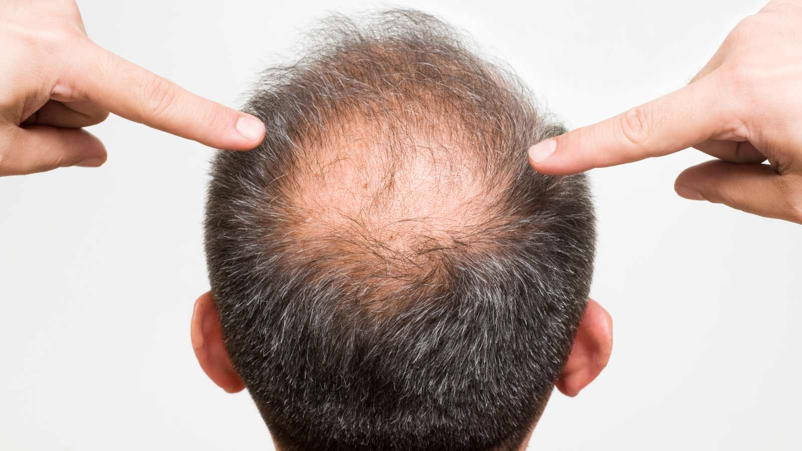 איך למנוע התקרחות